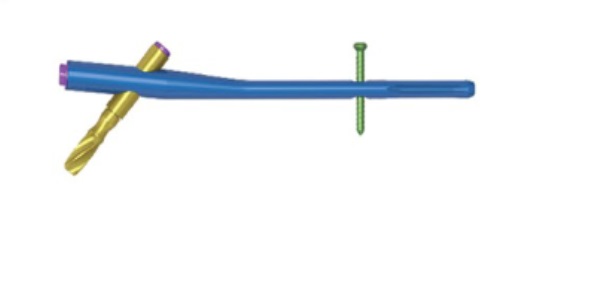 Стрижень ПФНА Джинлу